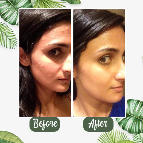 Removedor de Puntos Negros